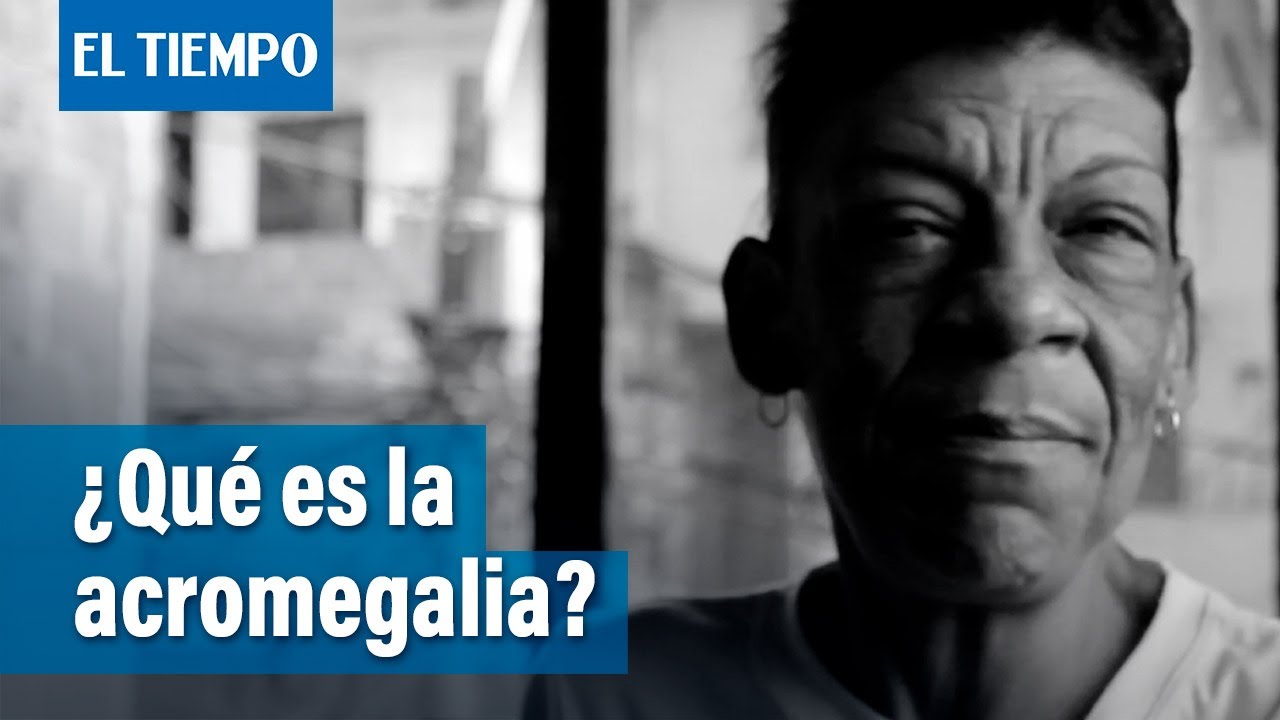 Especial enfermedades raras: acromegalia | El Tiempo