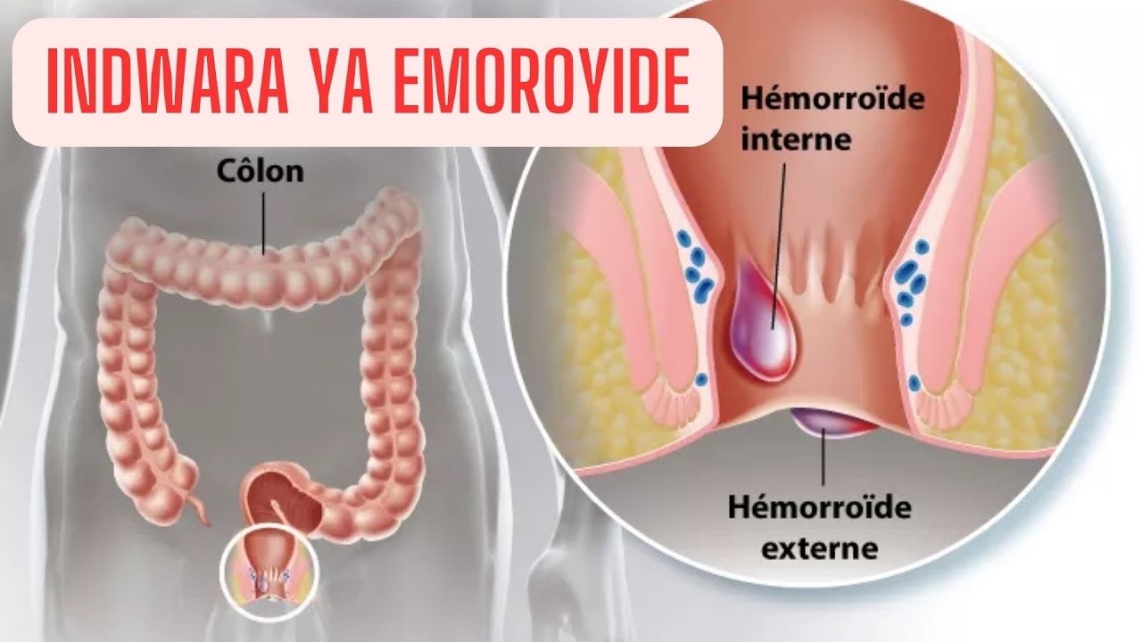 INDWARA YA HEMOROIDS (KARIZO) UKO WAYIVURA NIBIYITERA BURYA BURI WESE YAYIRWA