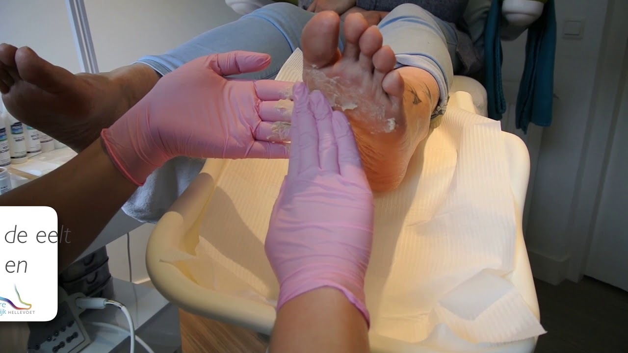 #4 Tutorial Eelt Verwijderen met de E&L Zalf!