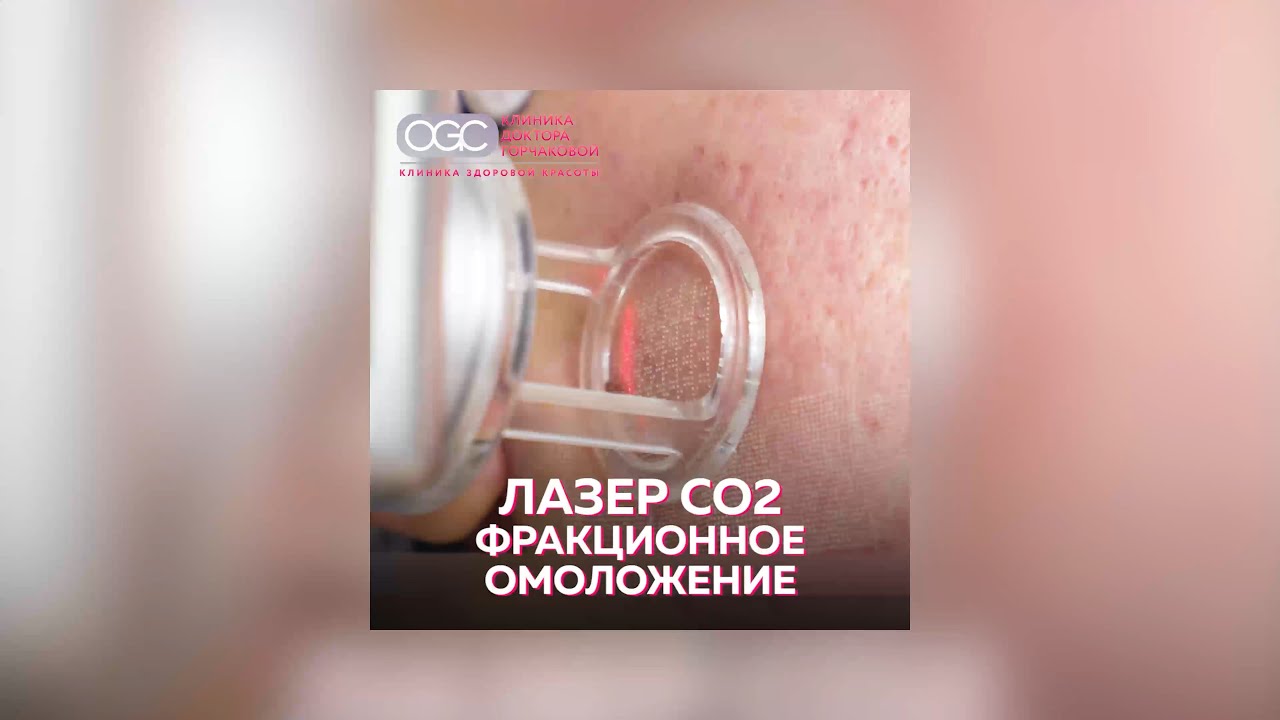 Лазерная шлифовка - фракционное омоложение CO2 - OGC clinic