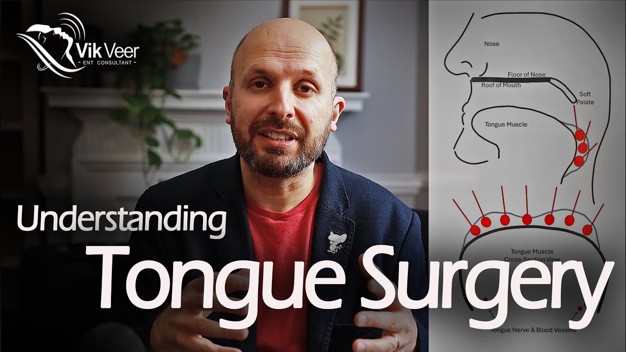 What you Need to Know about Tongue Surgery for Sleep Apnoea