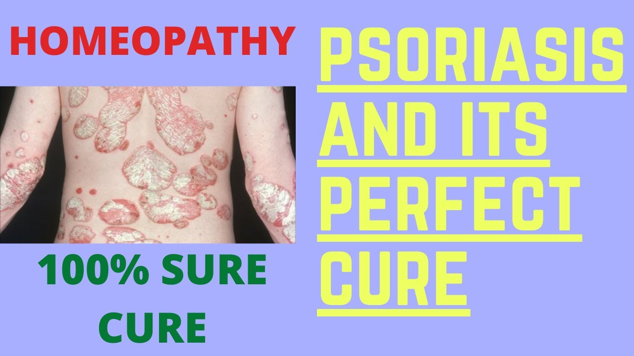 psoriasis || psoriasis homeopathic treatment in hindi || psoriasis homeopathy treatment in hindi !