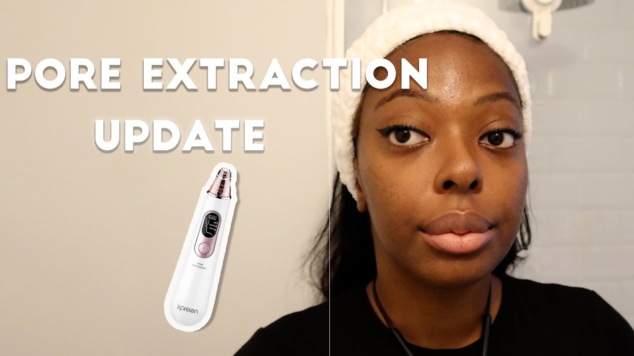 Amazon Blackhead Remover Pore Suction Before and After Update