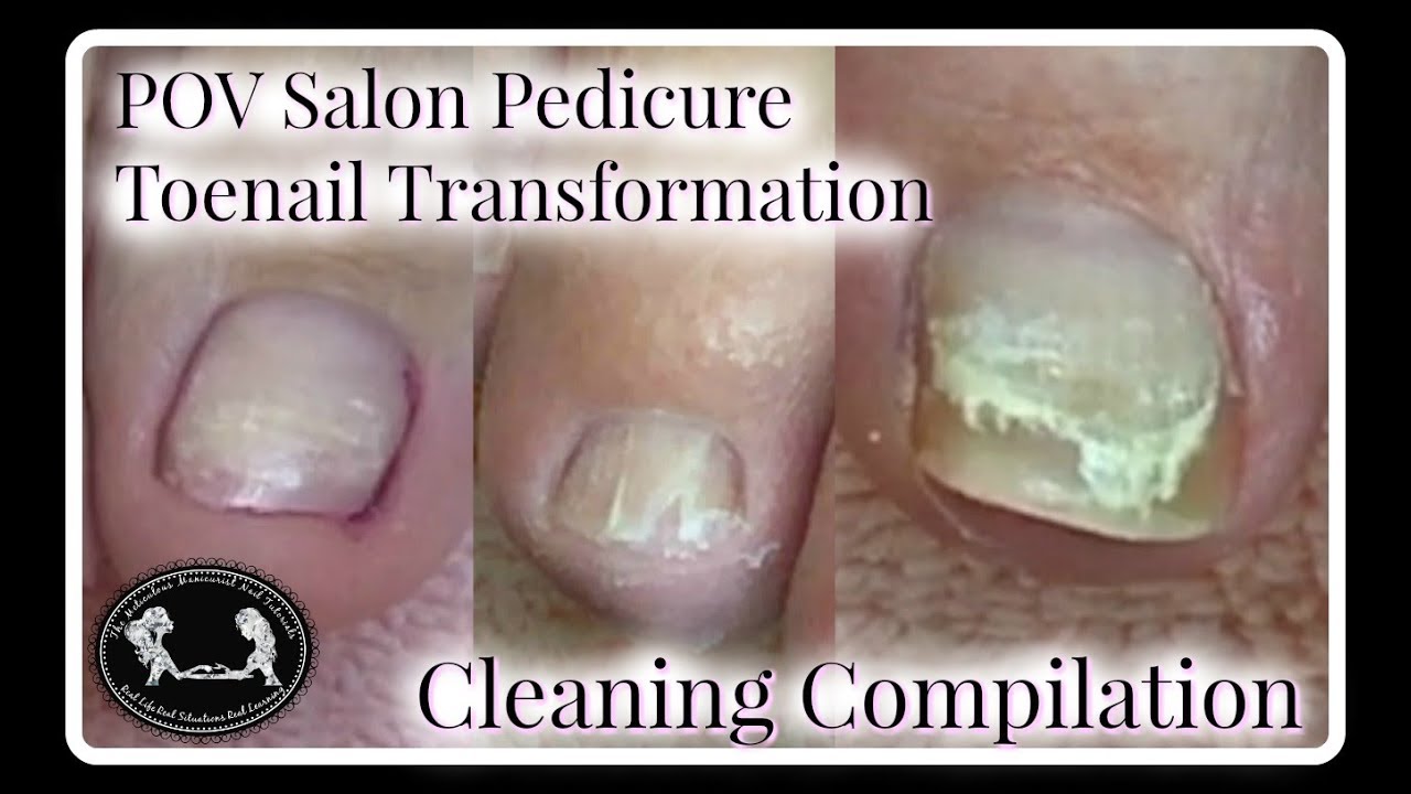 #3 POV Salon Pedicure Tutorial Toenail Transformation Compilation Big Toenail Cleaning ✔