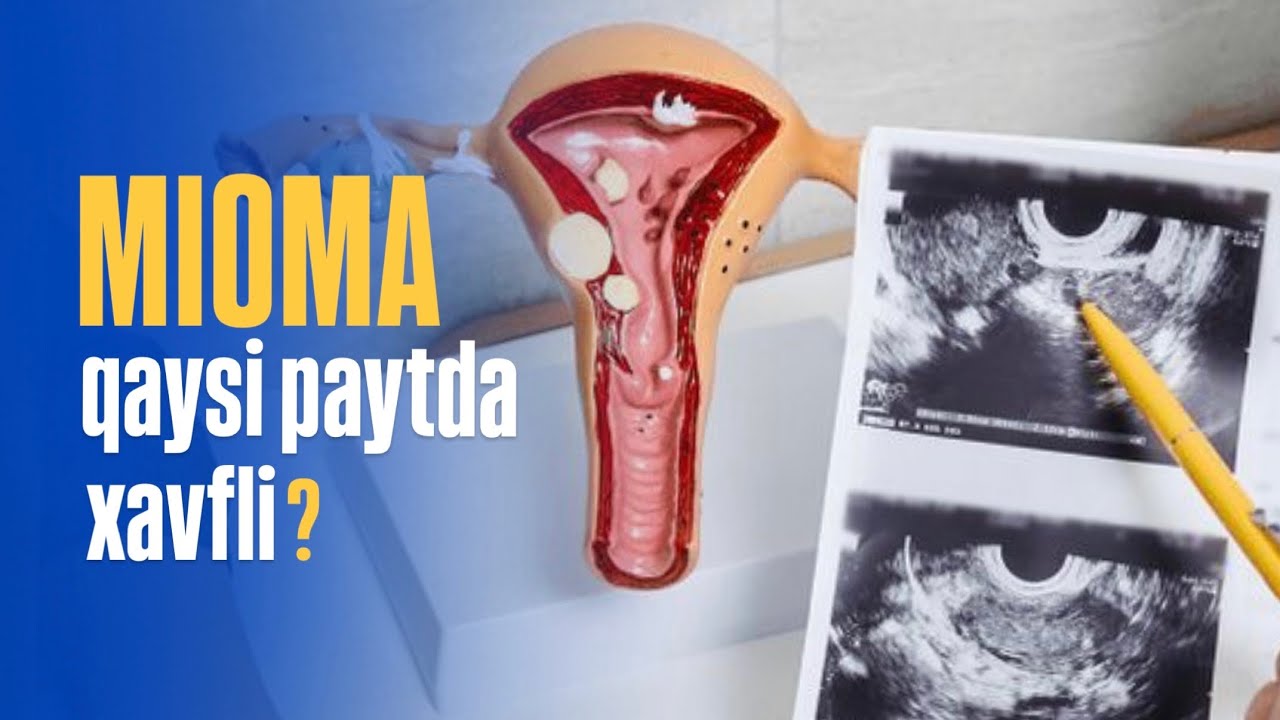 Mioma qaysi paytda xavfli?