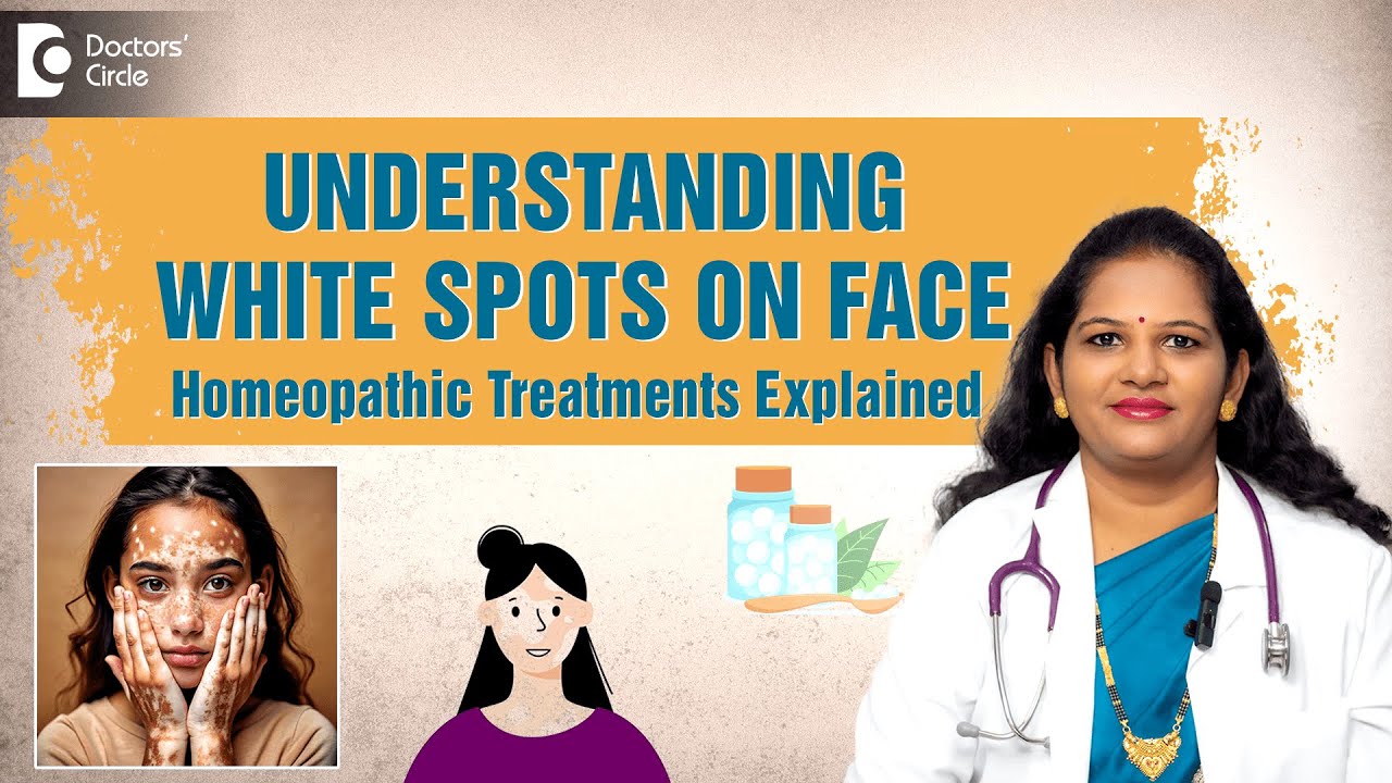 Get Rid of White Spots, Patches on Face with #homeopathicmedicine |Vitiligo, Pityriasis-Dr. Vindoo C