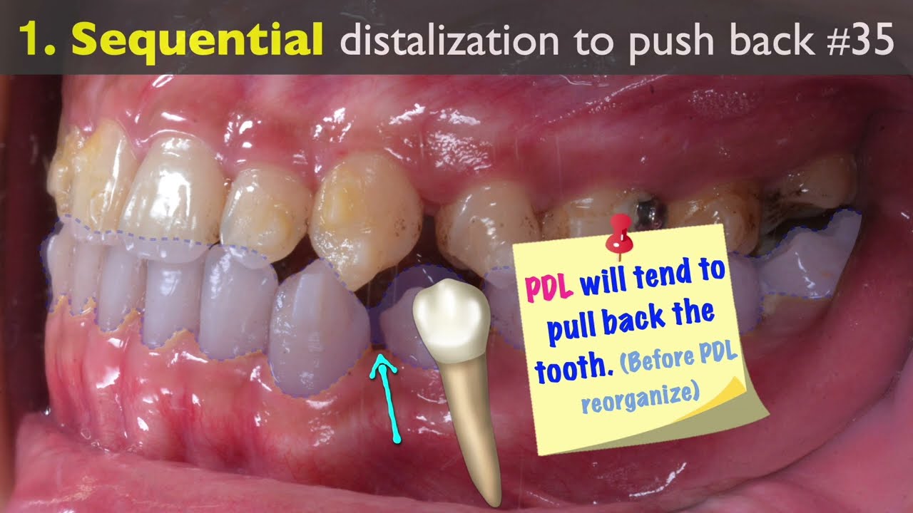 Class III Correction with Invisalign｜【Chris Chang Ortho】CC704