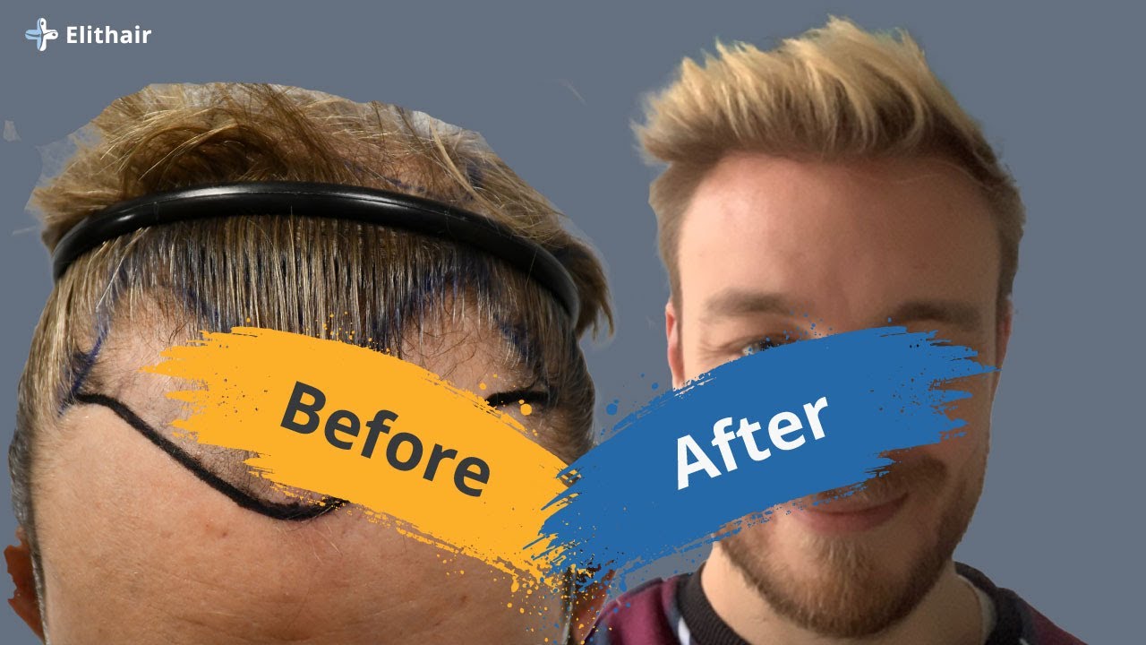 Hair Transplant Before and After - hair transplant time lapse