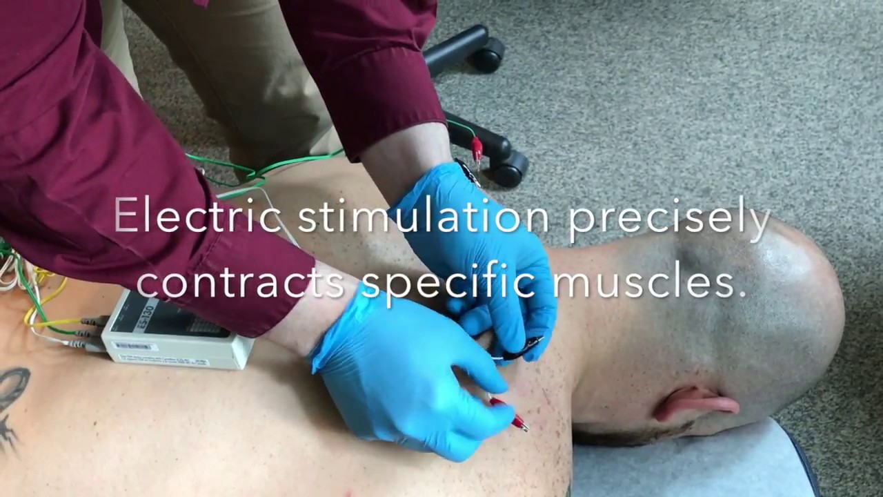 Electric Dry Needling