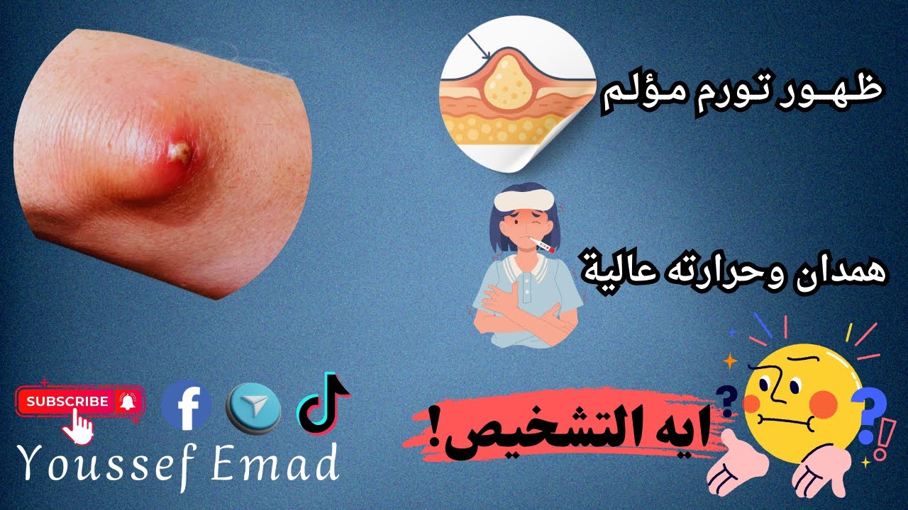 الخراج // في 3 دقايق اعرف ازاي تشخص وتعالج الخراج