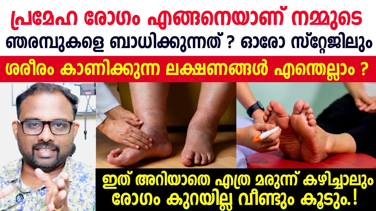പ്രമേഹം ഞരമ്പുകളെ ബാധിച്ച് തുടങ്ങിയോ ? എങ്ങനെ അറിയാം ? ഈ ലക്ഷണങ്ങൾ സൂക്ഷിക്കുക.! Diabetic neuropathy
