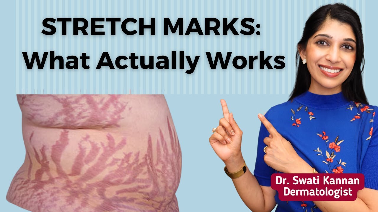 Fade Stretch Marks: Products and Treatments That Actually Work