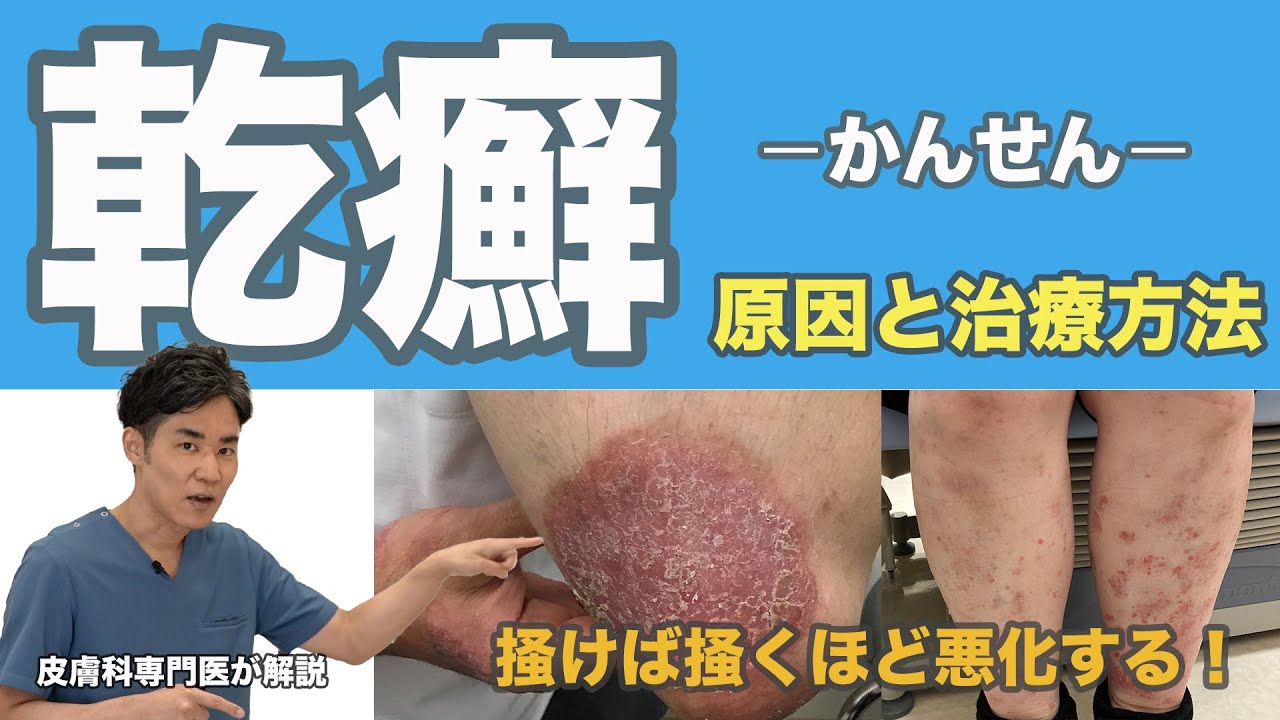 【乾癬と疥癬①】乾癬（かんせん）は掻けば掻くほど悪化する！