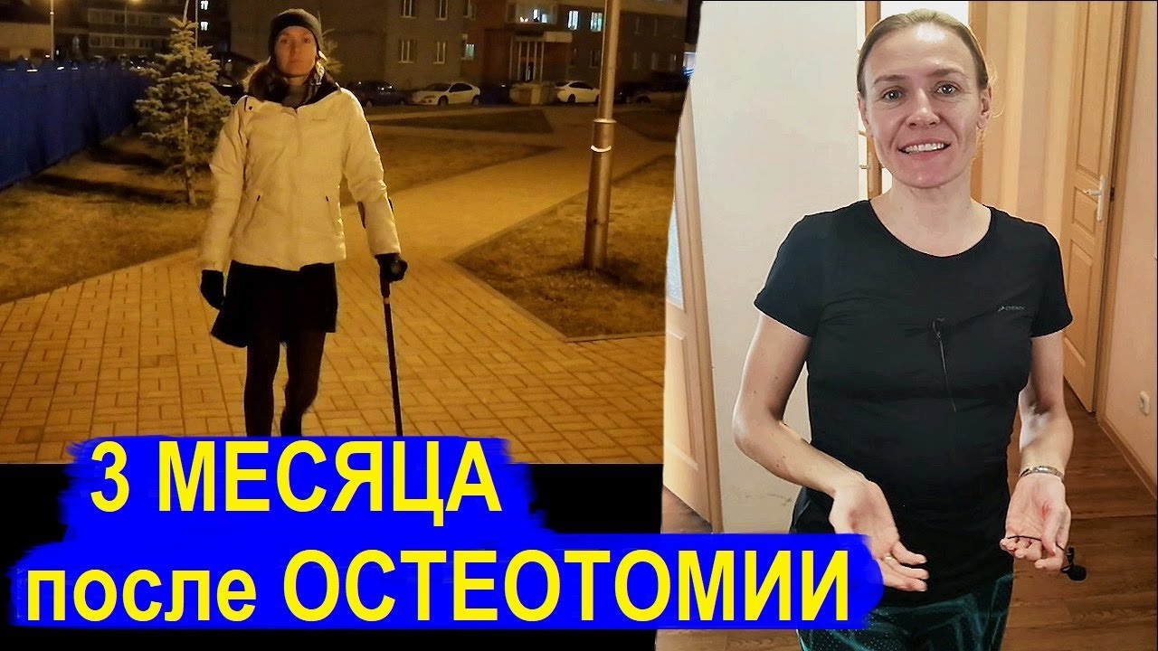 3 месяца после ОСТЕОТОМИИ: ПОХОДКА, ЗАРЯДКА, ОБРАЗ ЖИЗНИ, 90 ДНЕЙ на БОЛЬНИЧНОМ, что дальше?