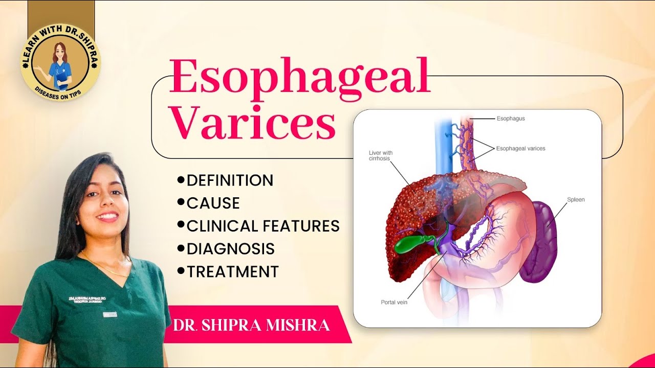Esophageal Varices in Hindi(Cause, Symptoms, Diagnosis, Treatment)|| Dr. Shipra Mishra ||
