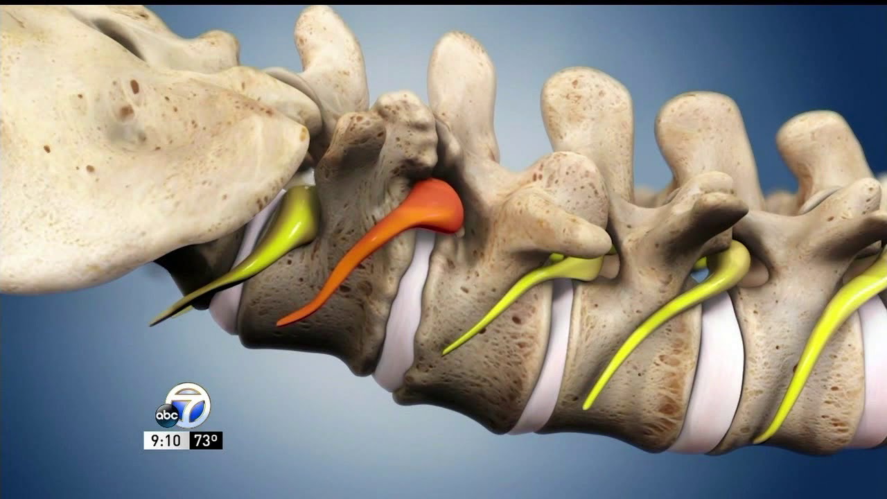ABC7- Dr. Schlesinger talks about the MIGLIF Procedure