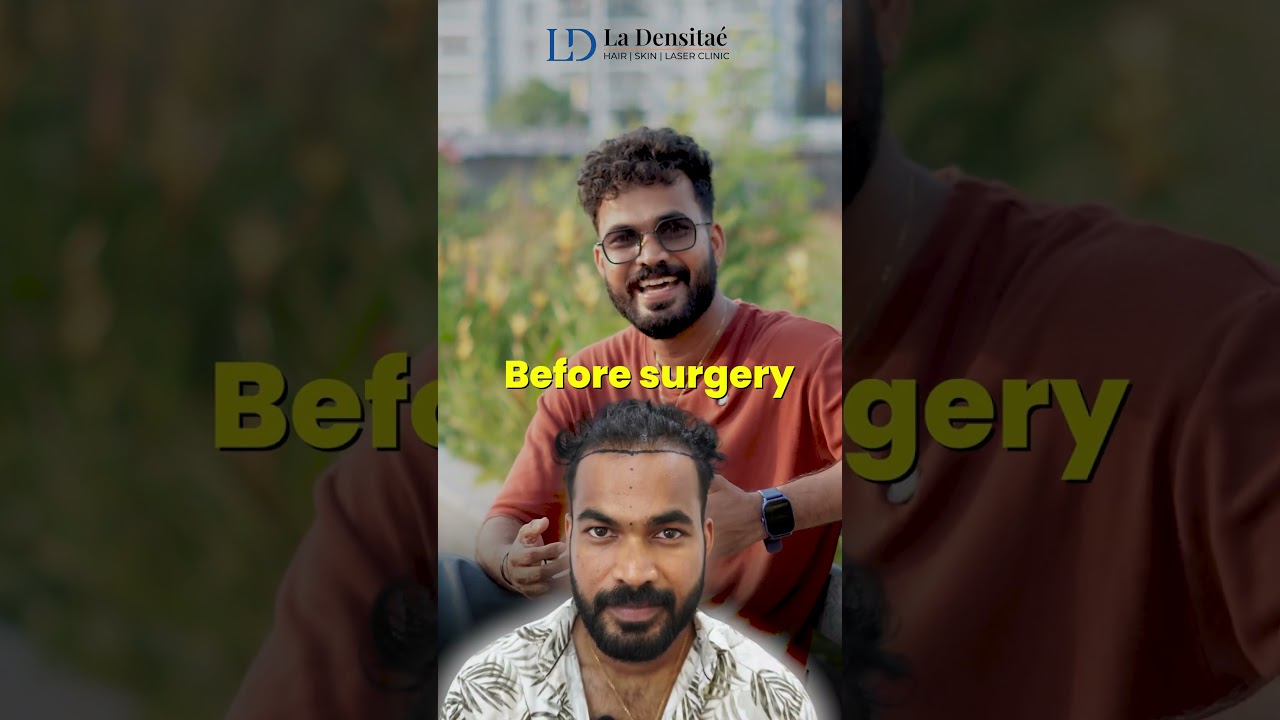 Rj Gaddafi 1 Year Hair Transplantation Reult | Ladensitae Hair Transplant Clinic