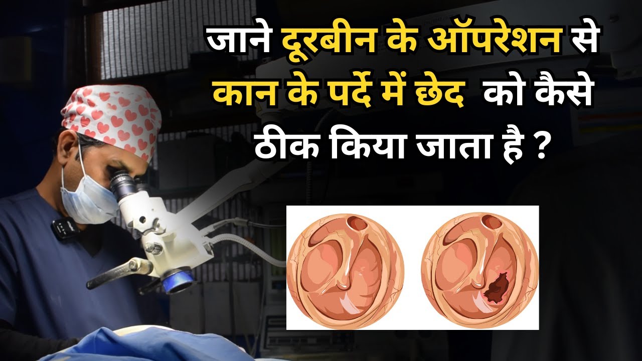 कान के पर्दे में छेद को कैसे ठीक करें? दूरबीन के ऑपरेशन से जानें |#perforation in #ear || Dr Sunil