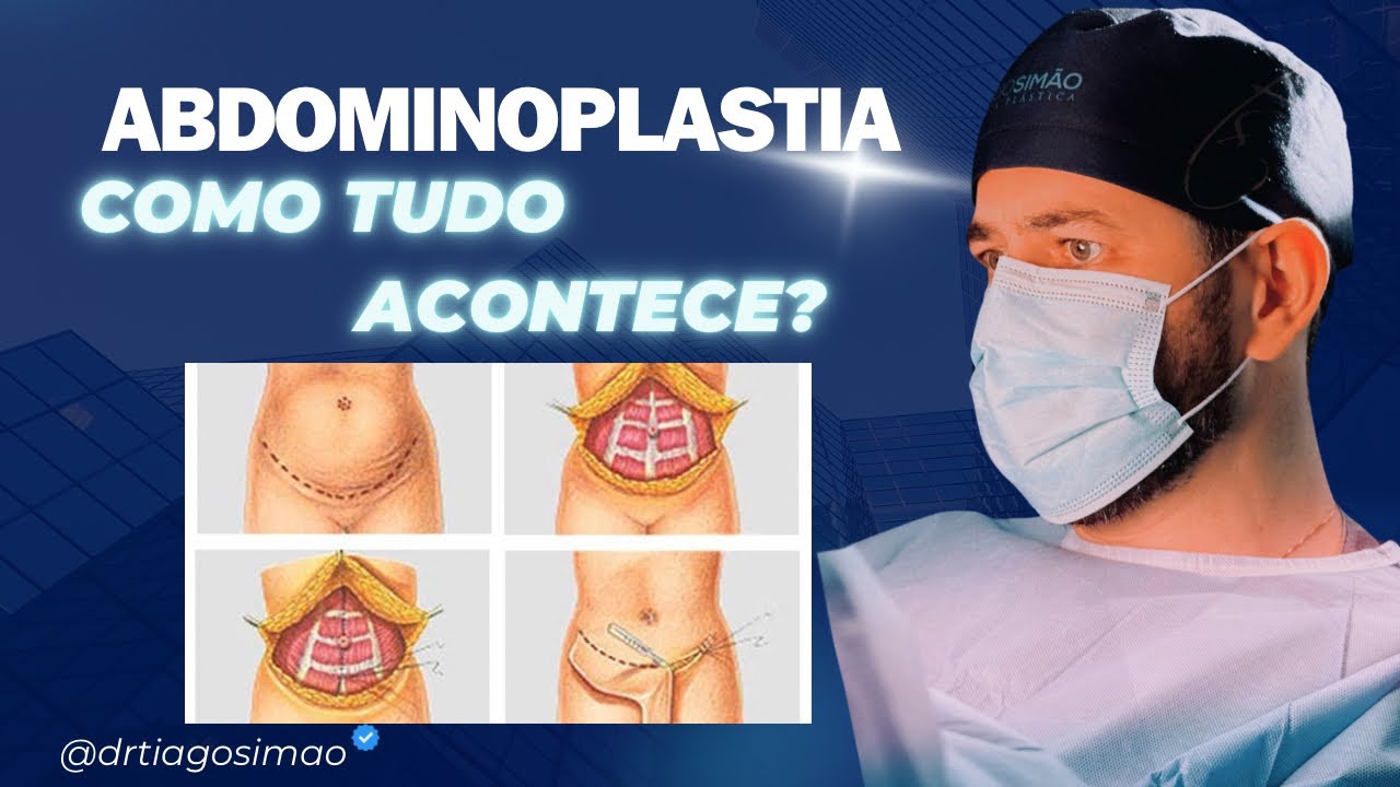 ABDOMINOPLASTIA | TUDO SOBRE ESSA CIRURGIA | PR&Eacute; / P&Oacute;S CIR&Uacute;RGICO!