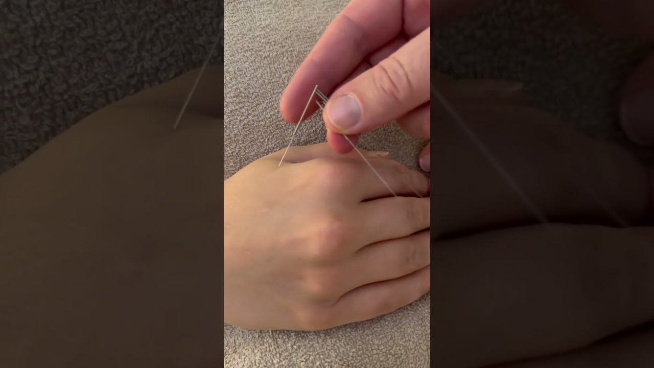 Acupuncture treatment for knee pain #kneepainrelief