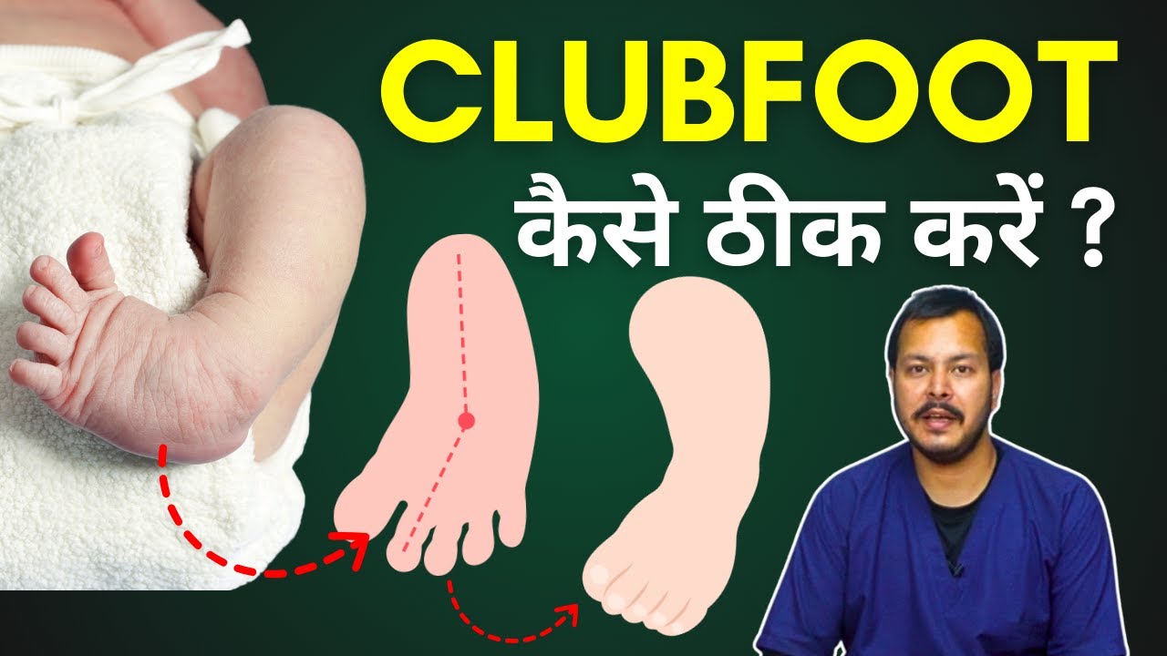 Clubfoot Physiotherapy Treatment, Massage, Exercise - क्लब फुट का इलाज कैसे करें?
