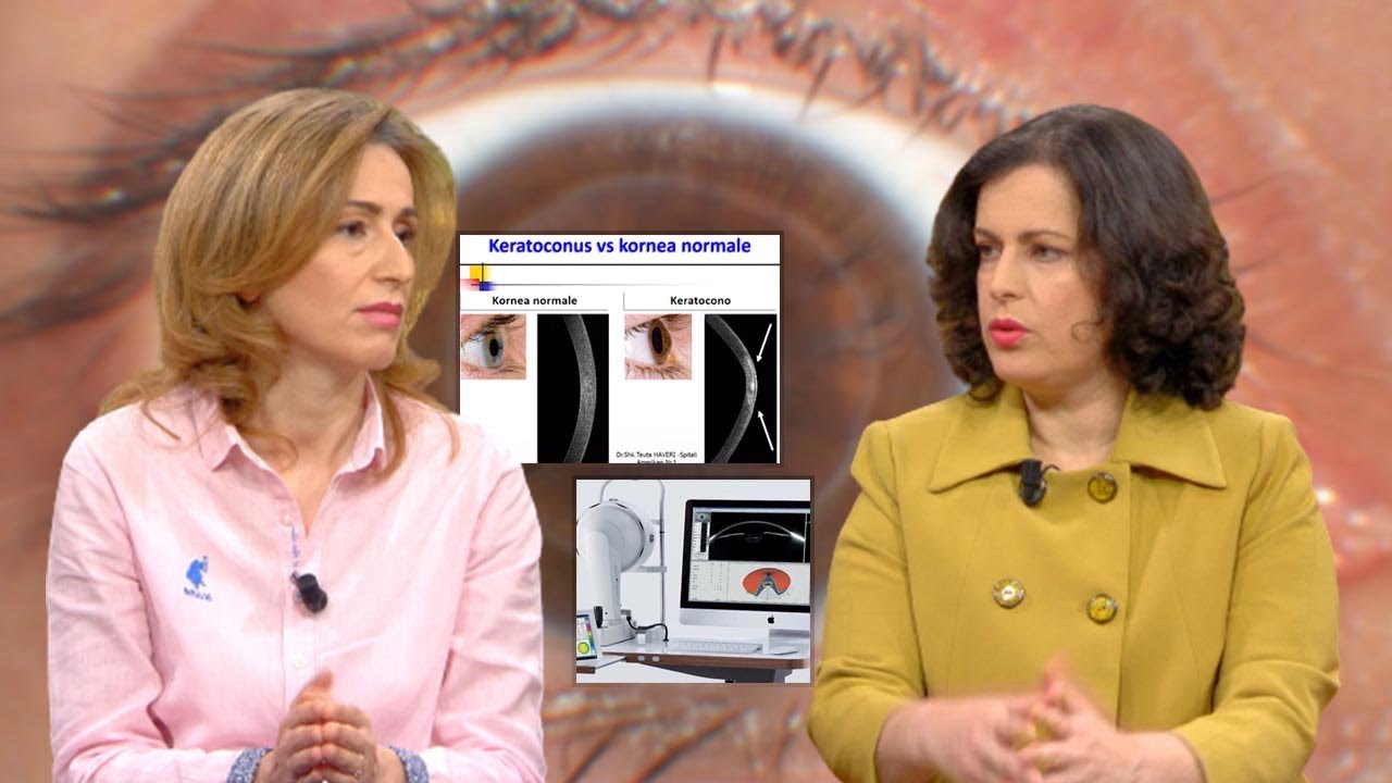 “Keratokonus”, semundja e syve tek te rinjte, mjeket shpjegojne kurimin me teknologjine e fundit