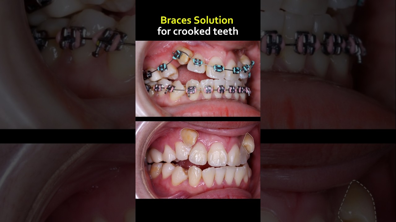 Braces best solution for crooked teeth #braces #dentist #orthodontist #teeth