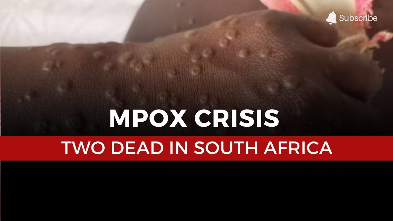 Mpox Crisis: South Africa Reports Second Death in 24 Hours