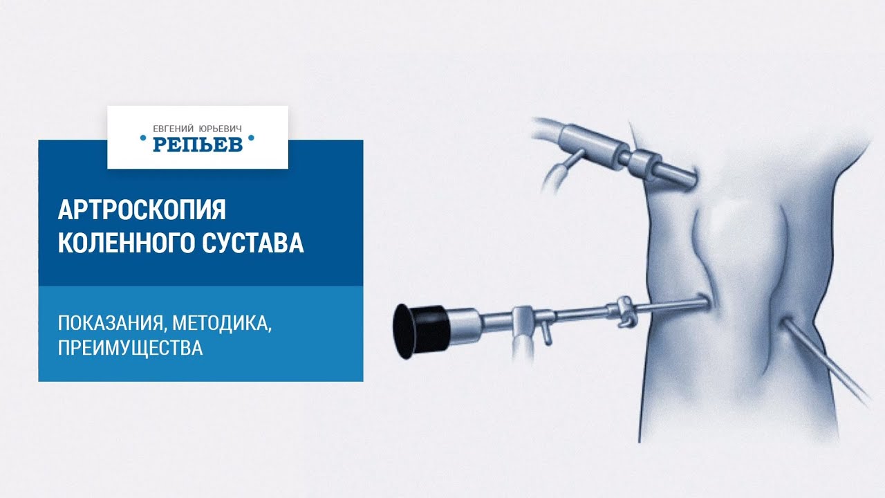 Артроскопия коленного сустава: показания, методика, преимущества