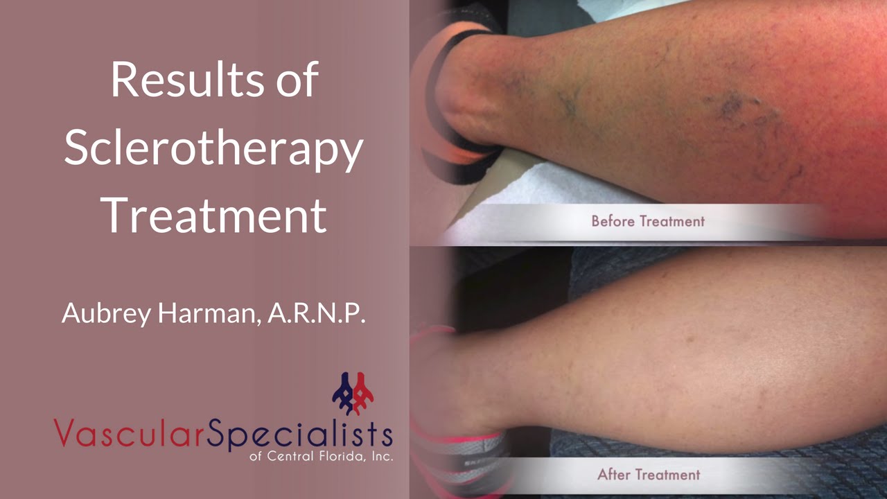 What Are the Results of Sclerotherapy Treatment?