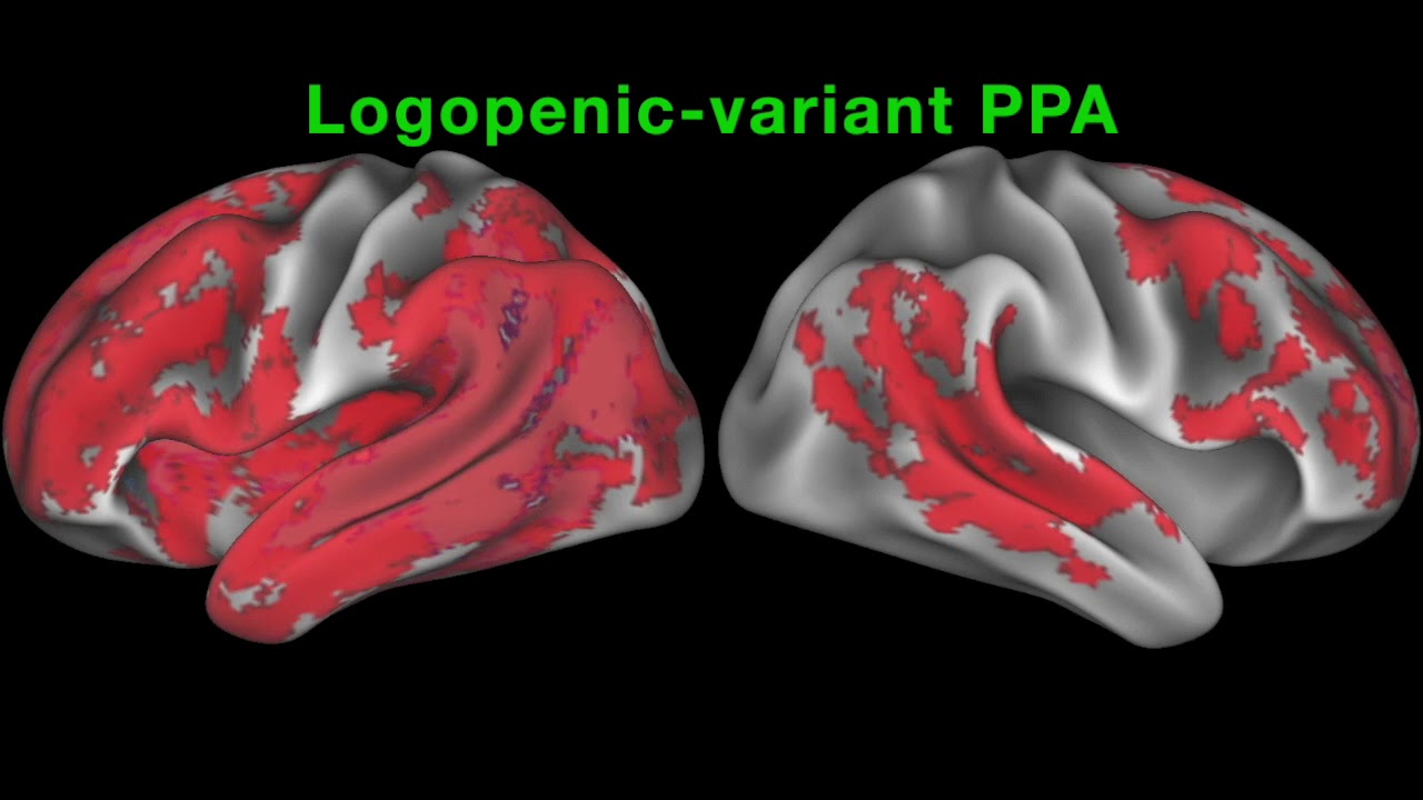 Longitudinal progression of grey matter atrophy in non-amnestic Alzheimer’s disease