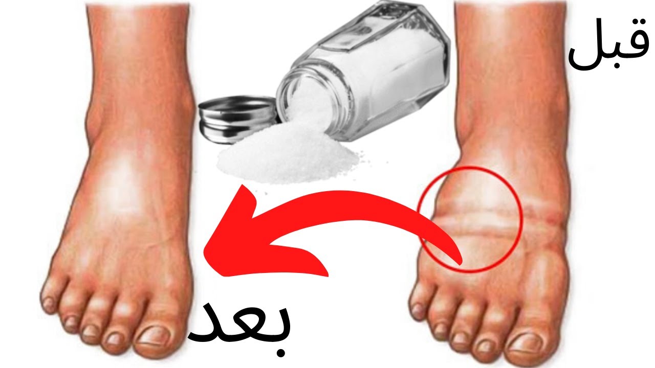 أهم  النصائح للتخلص من احتباس الماء بالجسم (الوذمة) الي بسبب انتفاخ