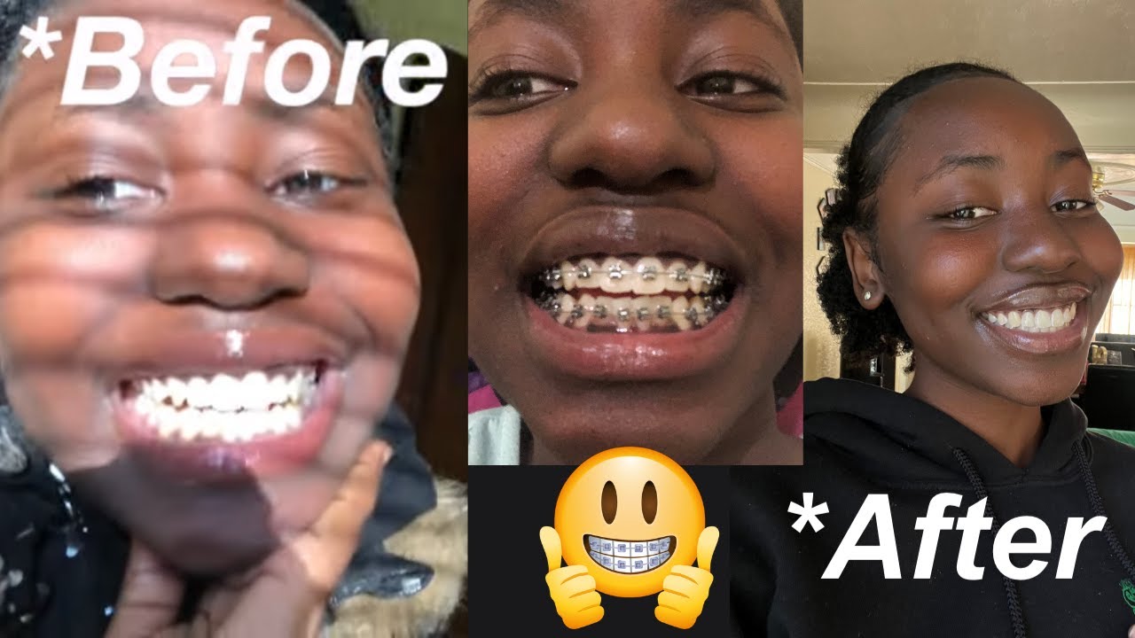 My Braces Journey (From Start To Finish)