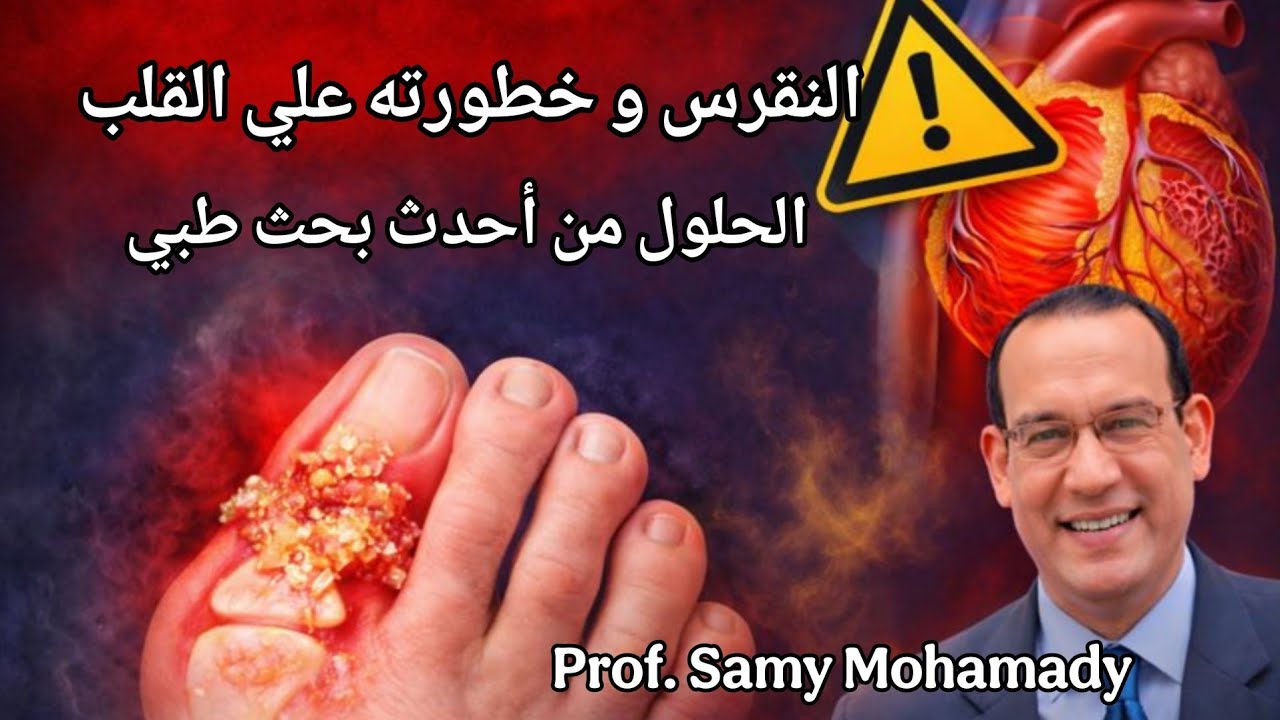 النقرس قد يدمّر القلب ويزيد خطر الجلطات | إليك الحل من أحدث الأبحاث الطبية