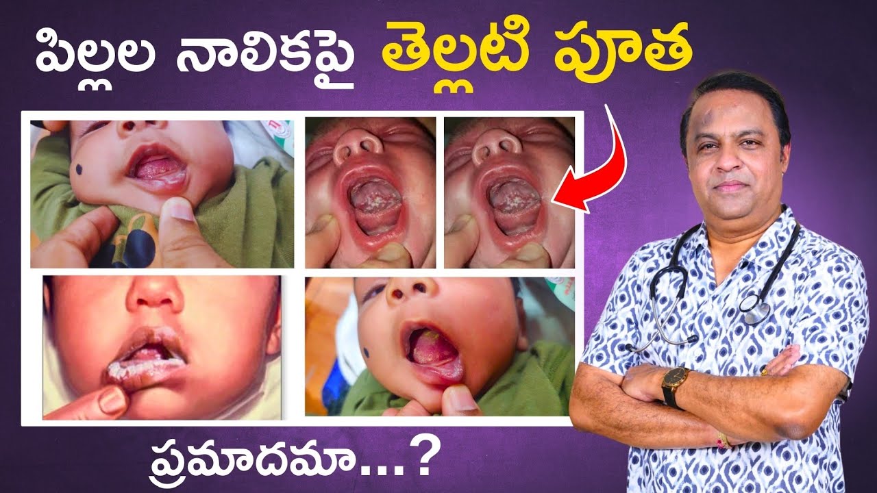 చిన్నపిల్లల నాలుకపై తెల్లటి పూత, white coating on baby tongue in telugu, oral thrush in babies