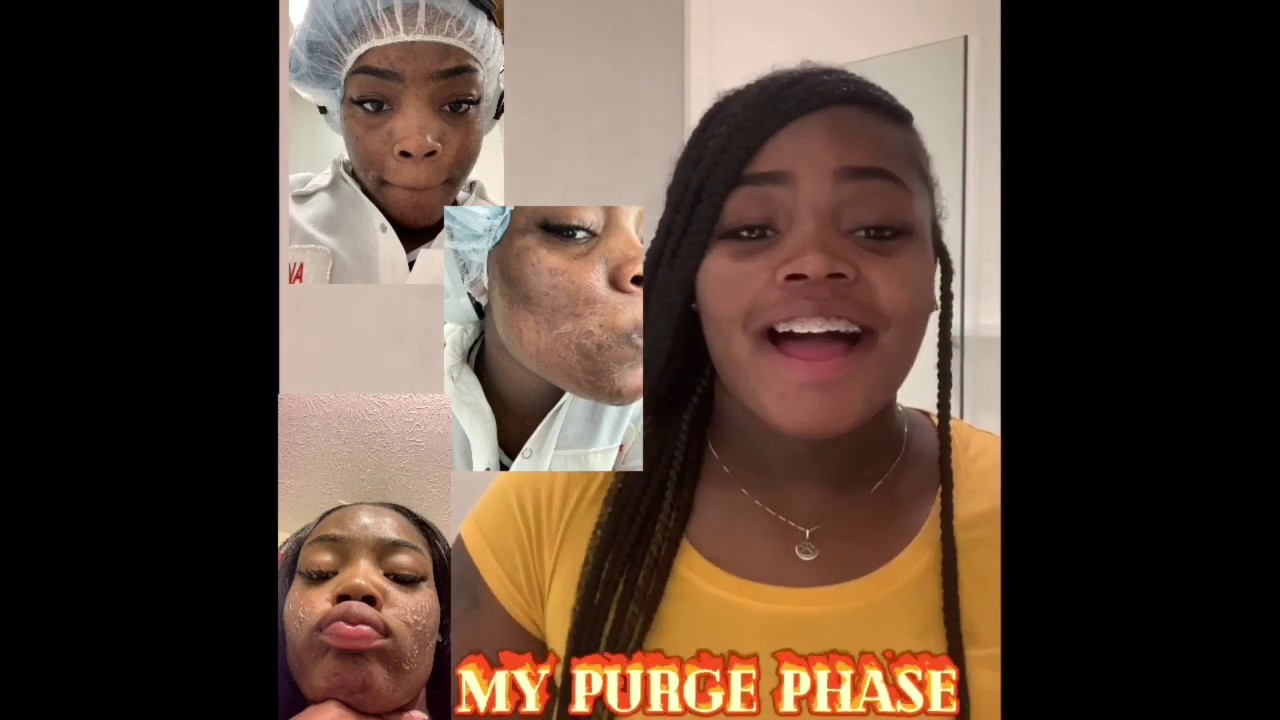 HOW I GOT RID OF MY ACNE USING TRETINOIN GEL ( SKIN CARE ROUTINE )