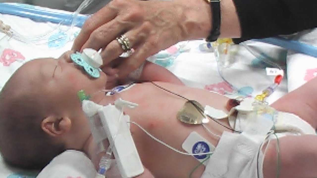 Single Ventricle Malformations - The Children's Hospital of Philadelphia (1 of 6)