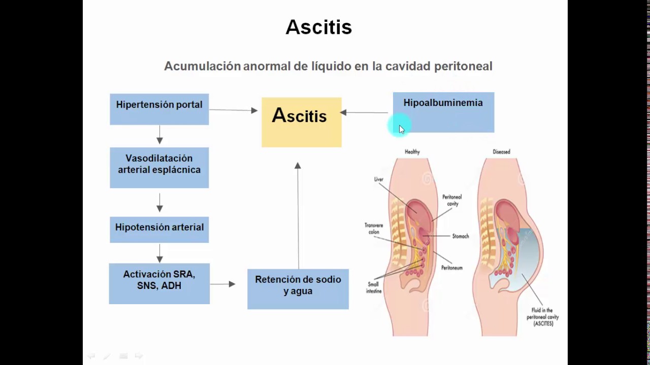 Complicaciones del daño hepático