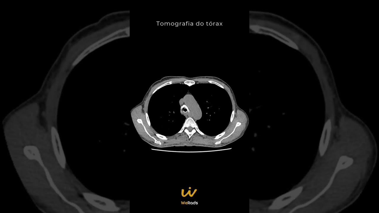 CASO DO DIA 2 - Tórax - Qual o SEU Diagnóstico?