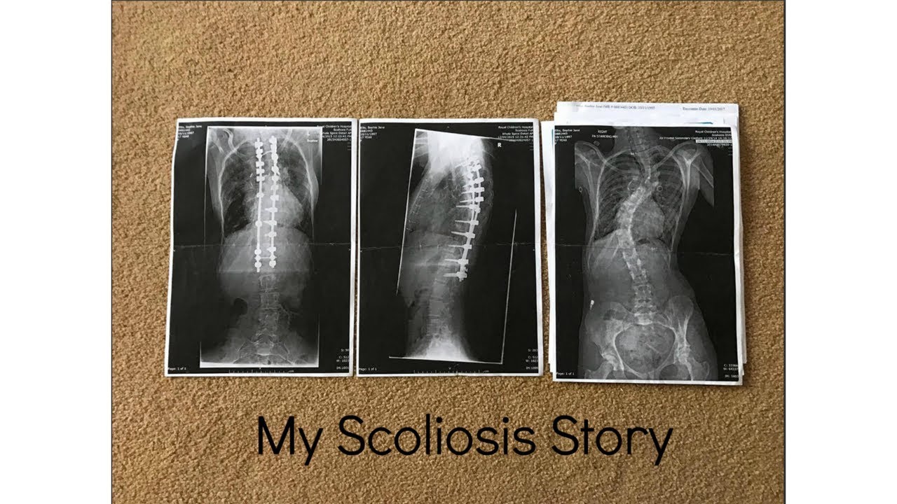 My Scoliosis Story