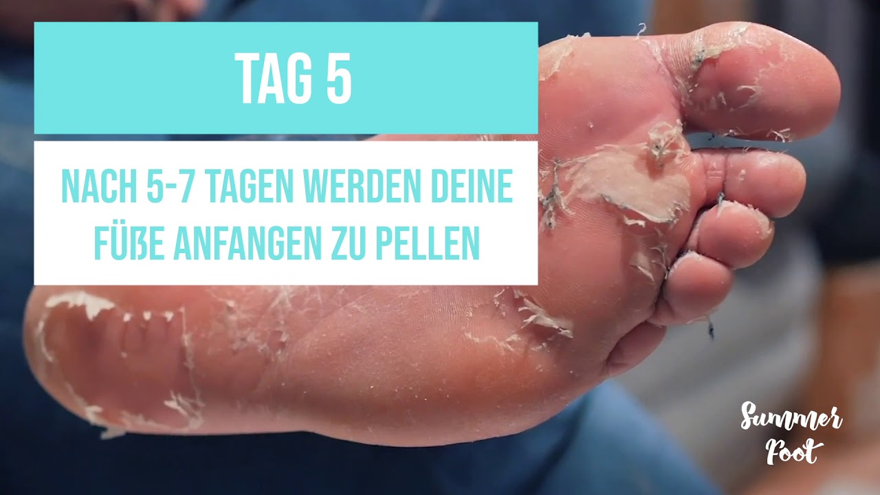 Summer Foot Peeling Fu&szlig;maske | Anwendung | Hornhaut Entferner Socken