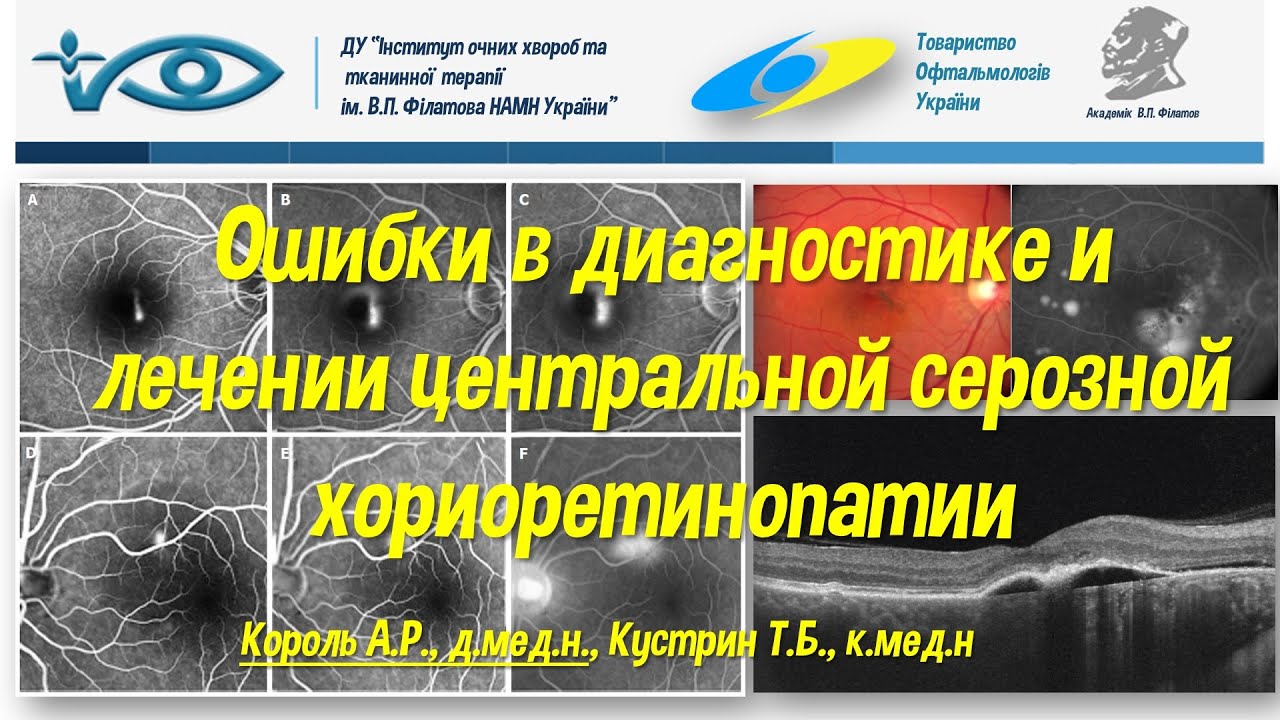 Ошибки в диагностике и лечении центральной серозной хориоретинопатии