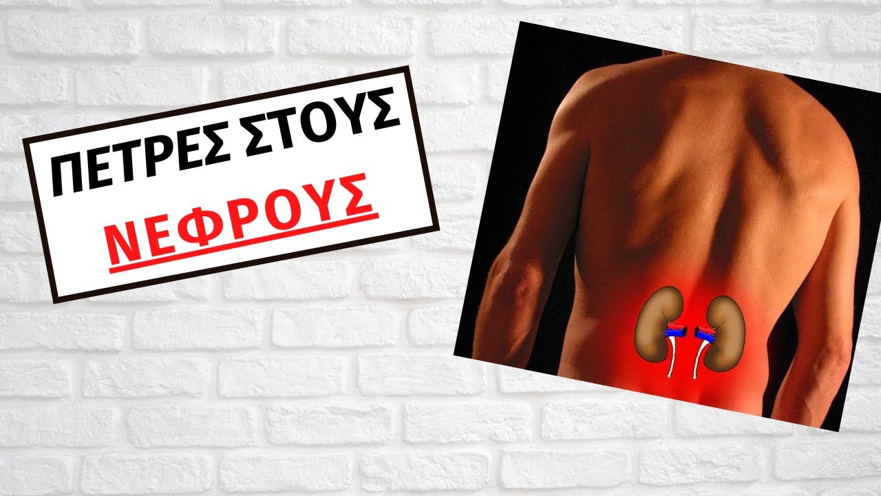 Πέτρες στους νεφρούς