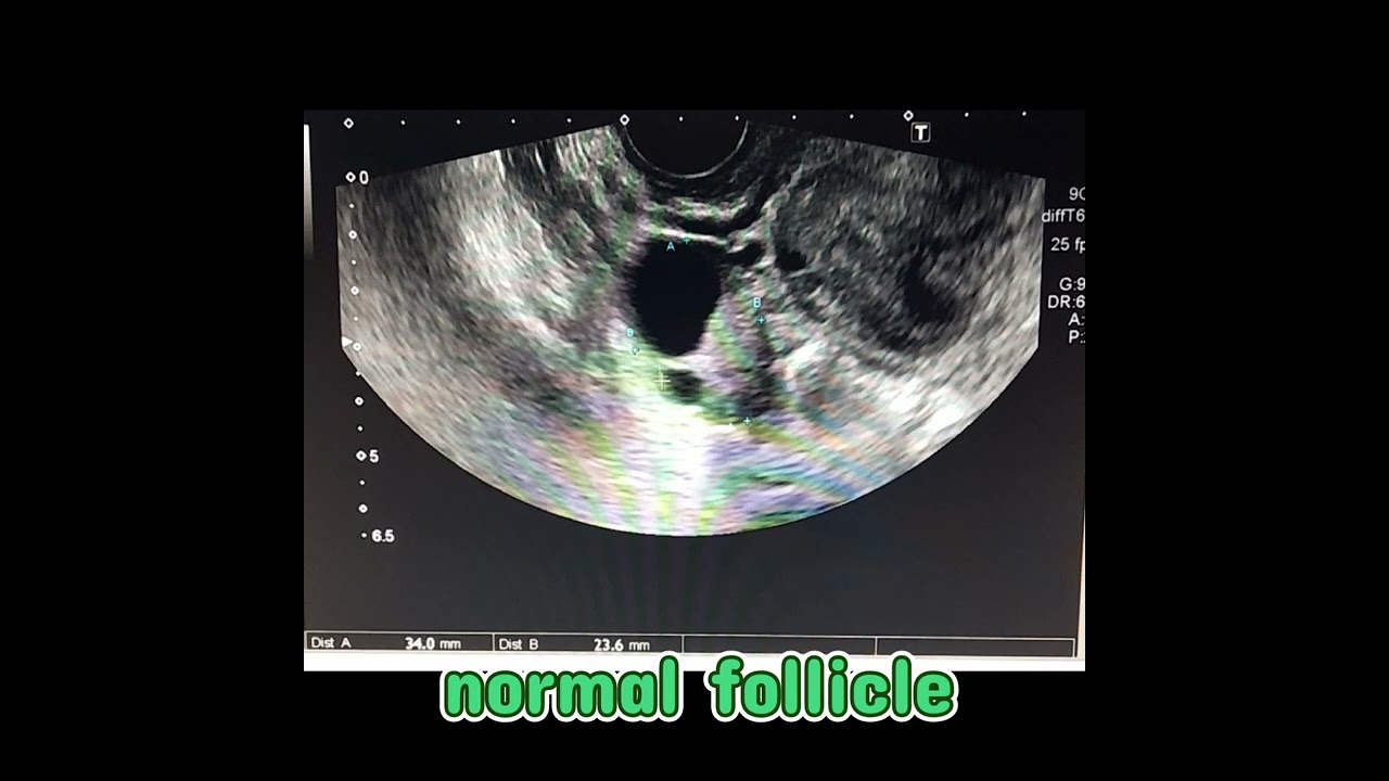 (الناضجه)ماهو مقياس البويضه الجاهزه للتلقيح