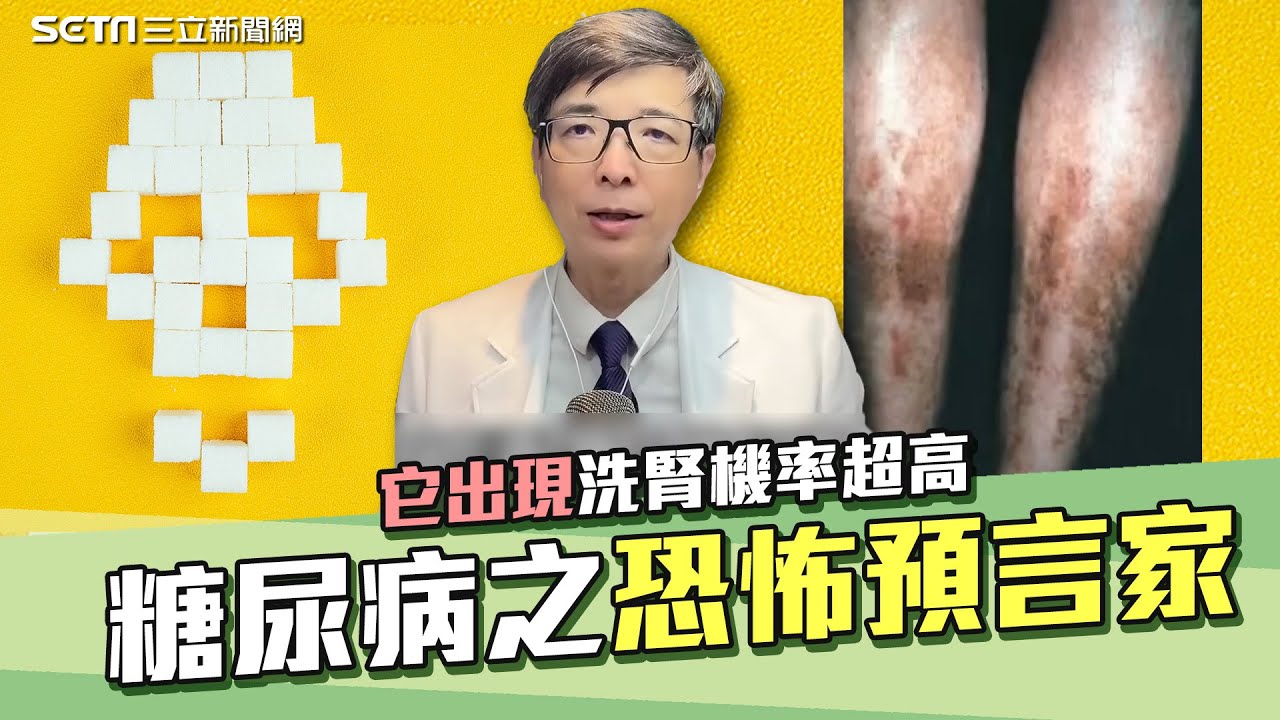 糖尿病恐怖預言家！拉褲管一看驚見「糖斑」醫師揭密糖尿病併發症 它一出現洗腎機率超高！冠心病、視網膜病變、糖尿病足通通來...超強5招逆轉 #糖尿病脛前黑斑｜腎寶思樂腎臟專科｜祝你健康