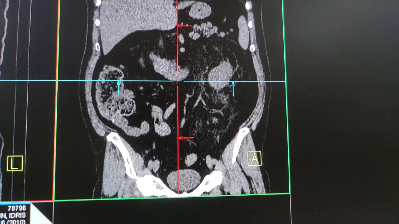Böbrek taşı nasıl anlaşılır? Böbrek taşı tomografi de nasıl görnür?