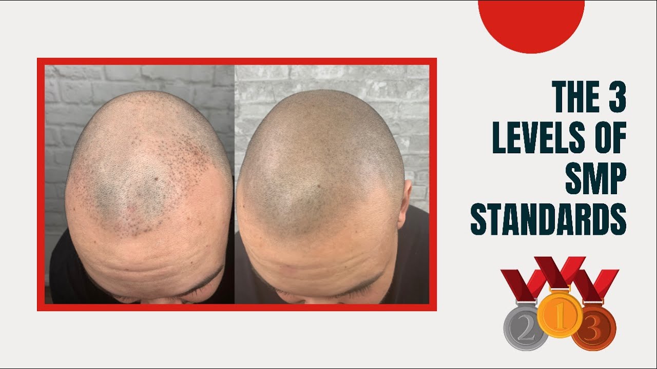 The Three Standards of SMP - 3 Different Levels of Scalp Micropigmentation