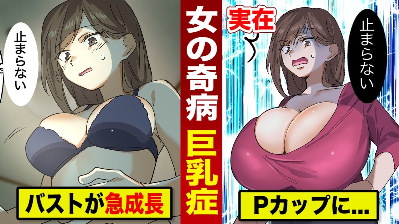 【実話】若い女の奇病...巨乳症。バスト突然が異常発達...Pカップになった一般人。