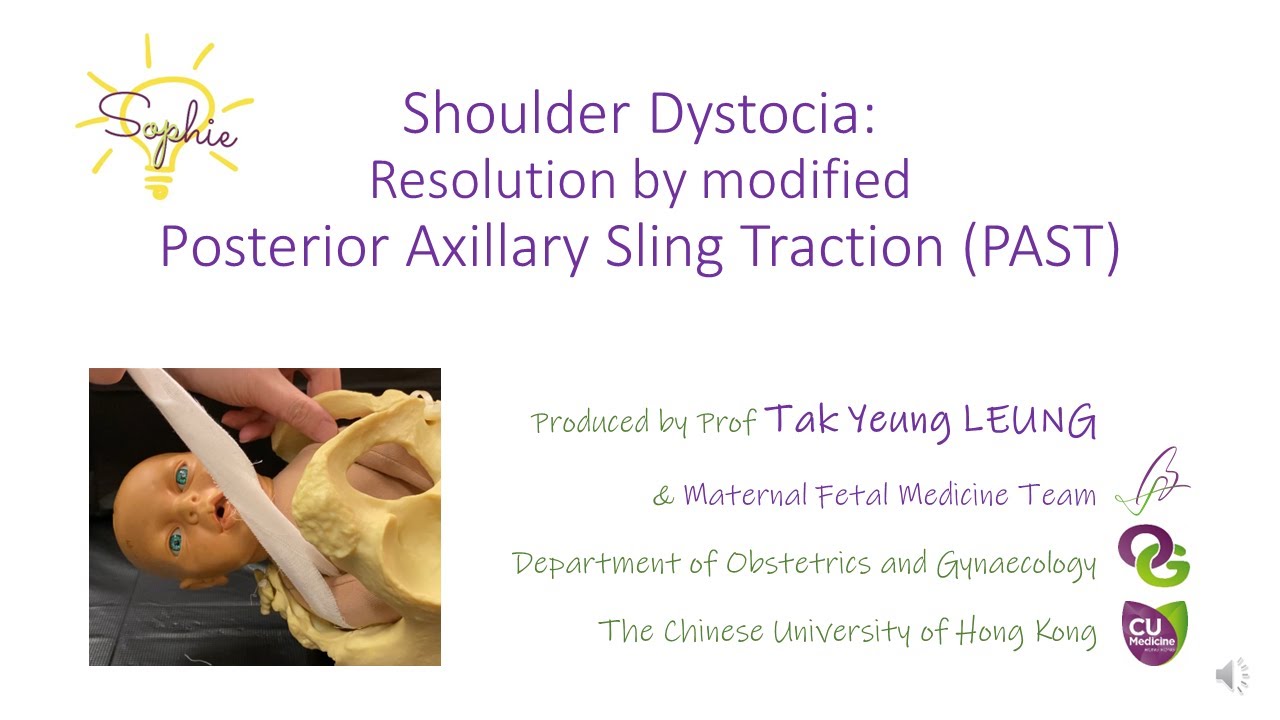 Shoulder Dystocia : Resolution by modified Posterior Axillary Sling Traction (PAST) - OBG CUHK