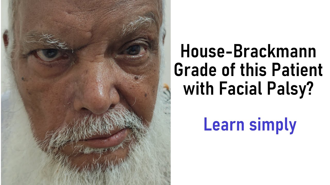 How to Determine the House-Brackmann Grade of a Patient with Facial Nerve Palsy with Simple Tricks